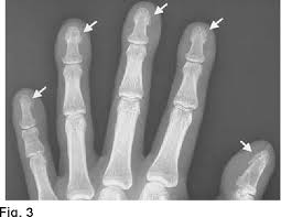 Image result for periostitis