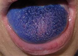 Image result for Taste Dysfunction