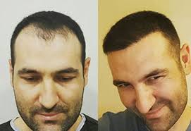 Candidates considering a hair transplant may find it useful. Hair Transplant Cost Turkey Hair Transplant Treatment Cost Turkey