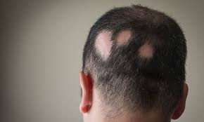 It does not imply a recommendation or endorsement by alopecia world. A Wearable Device For Hair Regrowth Drug Target Review