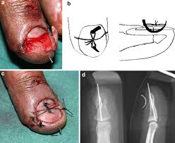The nail body is made of dead cells, but the nail bed (the tissue underneath the nail body) is alive. Surgical Treatment Of Acute Fingernail Injuries Journal Of Orthopaedics And Traumatology Full Text