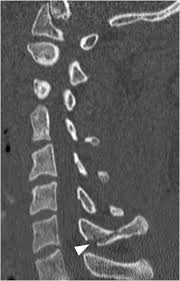 Tranverse process fracture classification / treatment. Typically Stable Subsection 3a Clinical Imaging Of Spinal Trauma
