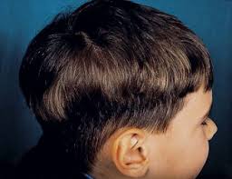 Heterochromia of the scalp hair: A result of pigmentary mosaicism?