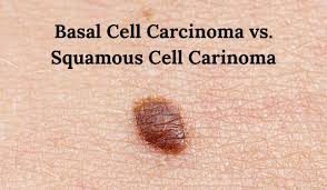 Large cell carcinoma is a type of lung cancer. Basal Cell Carcinoma Vs Squamous Cell Carcinoma Vujevich Dermatology