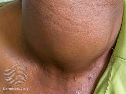 How To Tell A Lump From A Lymph Node