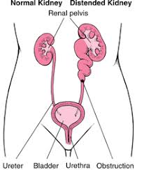 Urinary Tract Obstruction Kidney And Urinary Tract Disorders Urinary Tract Kidney Stones Symptoms Chronic Kidney Disease