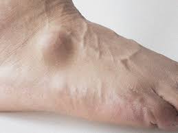 Lay the person flat on his back. Ganglion Cyst On Foot Pictures Cause Symptoms And Treatment