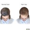 You might be able to reverse hair loss, or at least slow it. 3