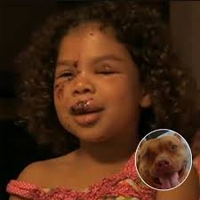 5-year-old gets bitten by neighbor's labrador