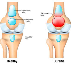 Bursa valiliği koordinasyonunda bursa i̇l millî eğitim müdürlüğü ile hayırsever karacabey ticaret borsası arasında, karacabey bursa. Bursitis Diagnosis Symptoms Treatment Msk Australia