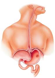 Browse 1,114 stomach ulcer stock photos and images available, or search for stomach pain or peptic ulcer to find more great stock photos and pictures. Untangle The Mystery Of The Peptic Ulcer Call Digestive Care Physicians