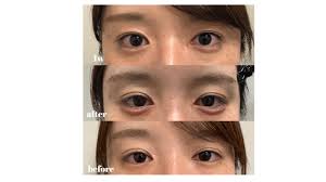 涙 袋 ヒアルロン 酸 ナチュラル