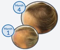 Offer valid for new patients only and cannot be combined with any other offers. Hair Loss Clinic Hair Loss Treatment The Belgravia Centre