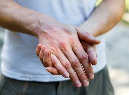 Image result for Atopic Dermatitis