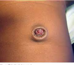 Image result for Umbilicus botryoides