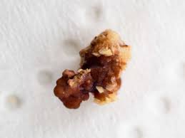 Earlier Studies Found A Link Between Temperature And Kidney Stones A New Project Finds That Heat Is Not The Only Kidney Stones Kidney Preventing Kidney Stones