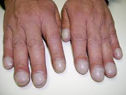 See more of sarah plummer jamberry nails independent consultant on facebook. Nail Clubbing Wikipedia