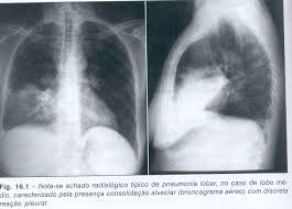 Pneumonias pneumonia is defined as acute inflammation of the lung parenchyma distal to the terminal bronchioles which consist of the respiratory bronchiole, alveolar ducts, alveolar sacs and. Pneumonia E A Fisioterapia Olharfisio
