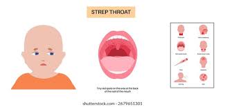 Image result for Strep throat infection roof of mouth