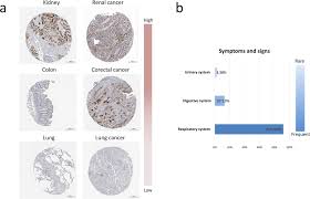 This happens most often with cancers of the pancreas, stomach, esophagus. Evaluation Of Covid 19 Based On Ace2 Expression In Normal And Cancer Patients