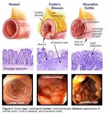 Image result for Ulcerative Colitis