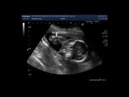 Clubfoot is a congenital deformity found in infants that results in the heel and toes treatments for clubfoot aim for a fully functioning, painless foot with little to no deformity present. Ultrasound Video Showing A Case Of Club Foot Also Called Talipes Equinovarus Tev Youtube