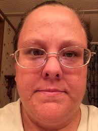 NF1, How many of you are blind or failing eyesight?