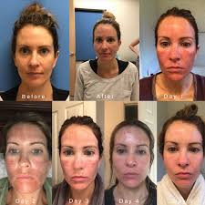 Our team has tested them all, so do let us know if you have any questions. Everything You Need To Know About Broadband Light Skin Treatments Bbl For San Francisco L P Aesthetics
