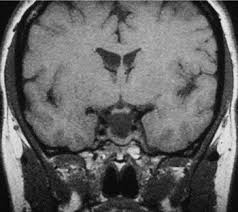 Image result for Incidental Imaging Finding