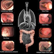 Pin On Cancer