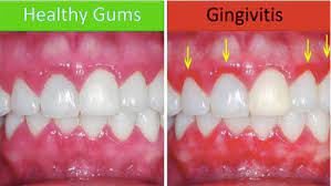 Studies show that baking soda significantly reduces dental plaque and gingival inflammation (7), (8). How To Reduce Oral And Systemic Inflammation