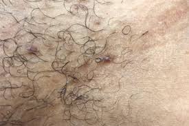 It can cause inflammation, pain and tiny bumps in the area where the hair was removed. Ingrown Hair Treatments Wimbledon Kensington Skin Clinics