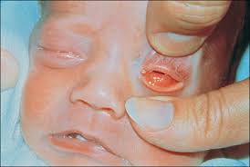 Image result for Gonococcal Conjunctivitis