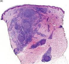 Image result for Nodular Lymphangitis