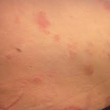 Autoimmune Progesterone Dermatitis Mdedge Dermatology