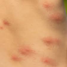 Image result for mosquito bite