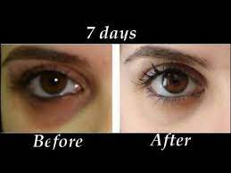 How To Get Pink Lips X2f Lighten Dark Lips Naturally At Home X2f Diy Miracle Remedies Youtub Dark Circles Around Eyes Dark Circles Treatment Dark Circles