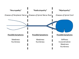 Radiculopathy Definition Myelopathy Org