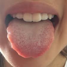 Habe Ich Candida Leaky Gut Syndrom Zungenbild Gesundheit Und Medizin Krankheit Pilze
