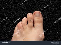 Image result for Yellow nail syndrome feet