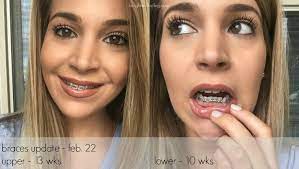 Pin On Brace Face