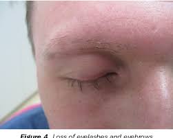 10 possible causes of hair loss frequently are present in patients with hiv, including chronic hiv infection itself, acute and chronic systemic infections, local infections, nutritional deficits, immune and endocrine dysregulation, and exposure to multiple drugs. Diffuse Hair Loss In Secondary Syphilis In Hiv Positive Man Case Report Semantic Scholar