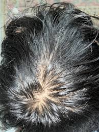 Image result for lice vs dandruff