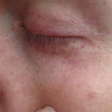 Ausschlag Um Das Auge Augen