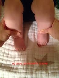 Club foot is easy to recognize. Positional Clubfoot