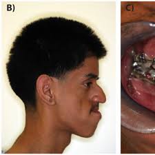 CT imaging following three months of consolidation. A) Sagittal...