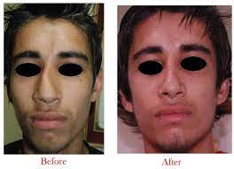 For details about nose job cost in pakistan, lahore contact now whatsapp +923445203650 or call 03445203650. Nose Surgery In Delhi Nose Surgery Cost In Delhi Nose Surgery Price In India Dr Vivek Kumar