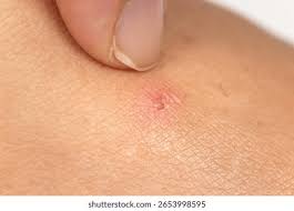 Image result for flea bites