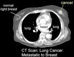 Breast cancer affects over 200,000 women each year. Breast Mass Found On Ct Scan Ct Scan Machine