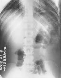 Image result for Abdominal XRay